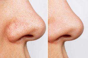"Pore Refining